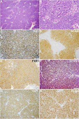 Exploiting embryonic niche conditions to grow Wilms tumor <mark class="highlighted">blastema</mark> in culture
